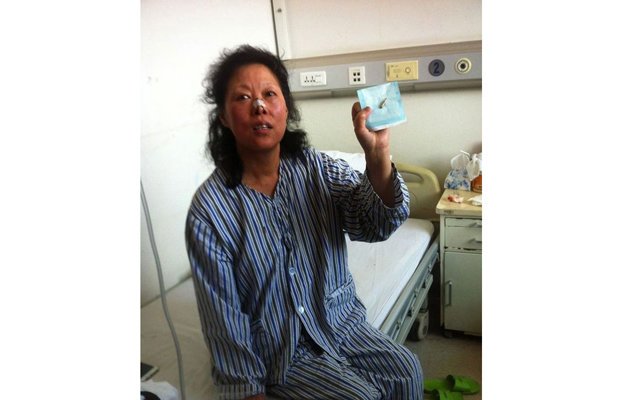 Китайские медики вытащили пулю из носа женщины
