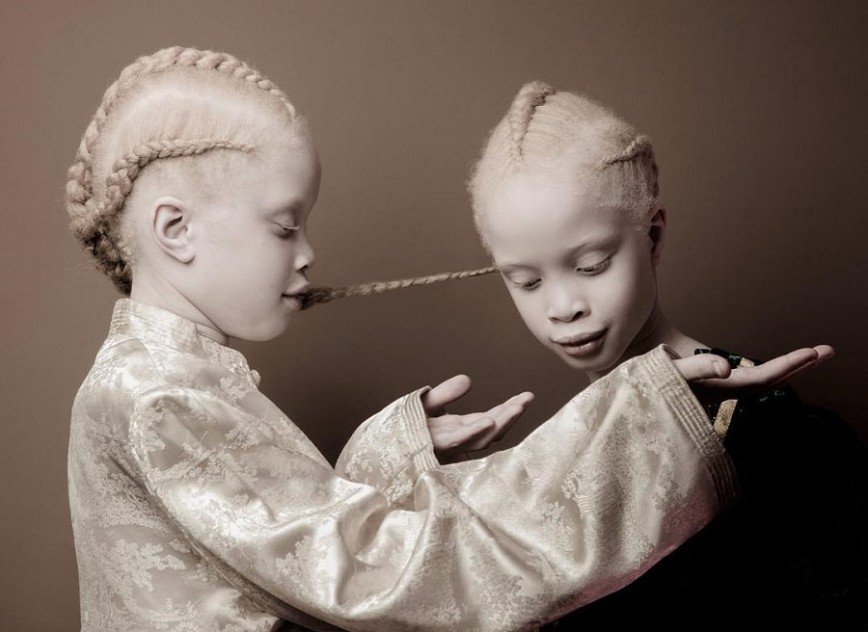 Близняшки-альбиносы из Бразилии штурмуют модную индустрию