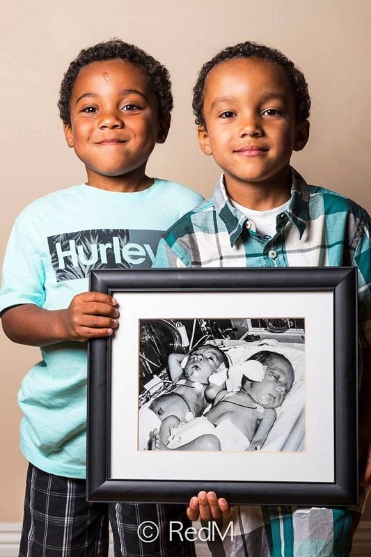 Сквозь годы: трогательные фото детей, родившихся недоношенными