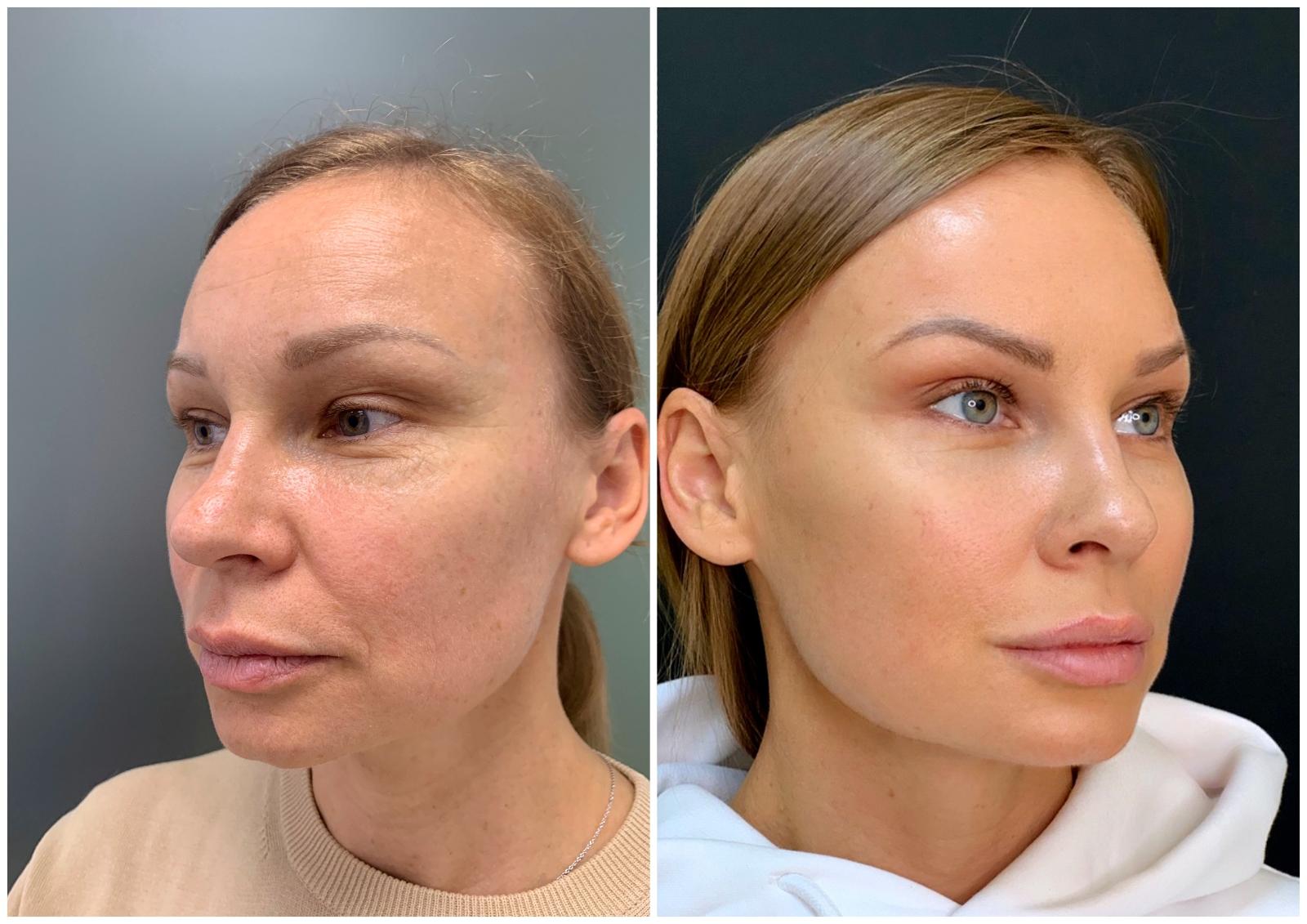 До и после процедуры в «Frau Klinik»