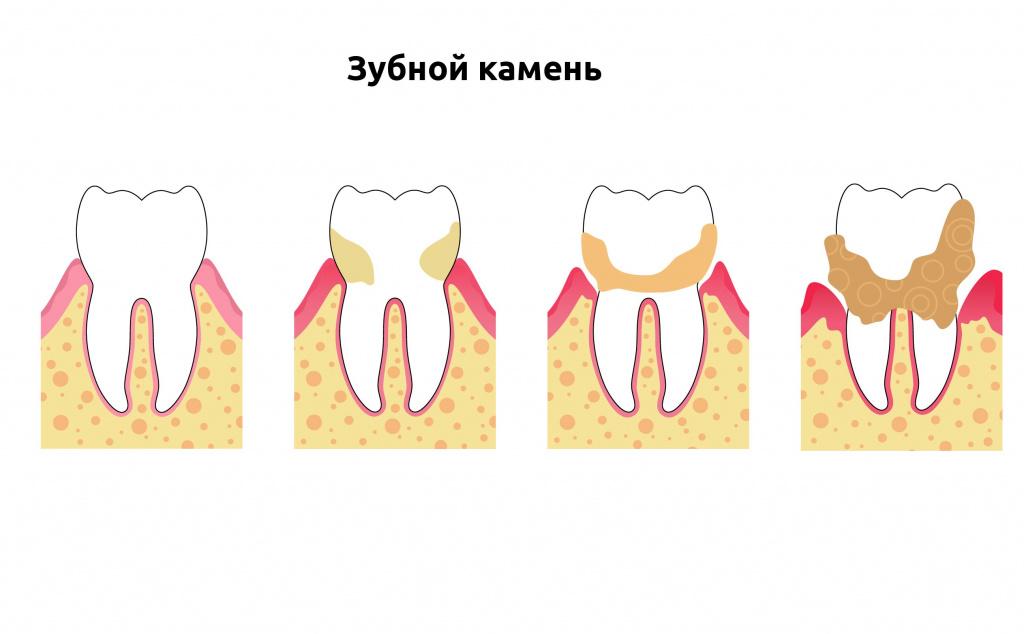 Возникновение зубного камня 