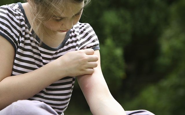 Как устранить зуд и воспаление от комариного укуса