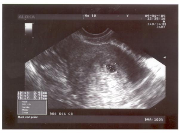 УЗИ 3-4 недели беременности
