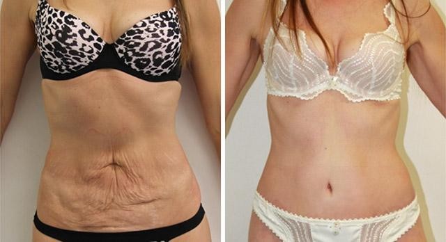 грудь после беременности и родов фото до и после фото 22